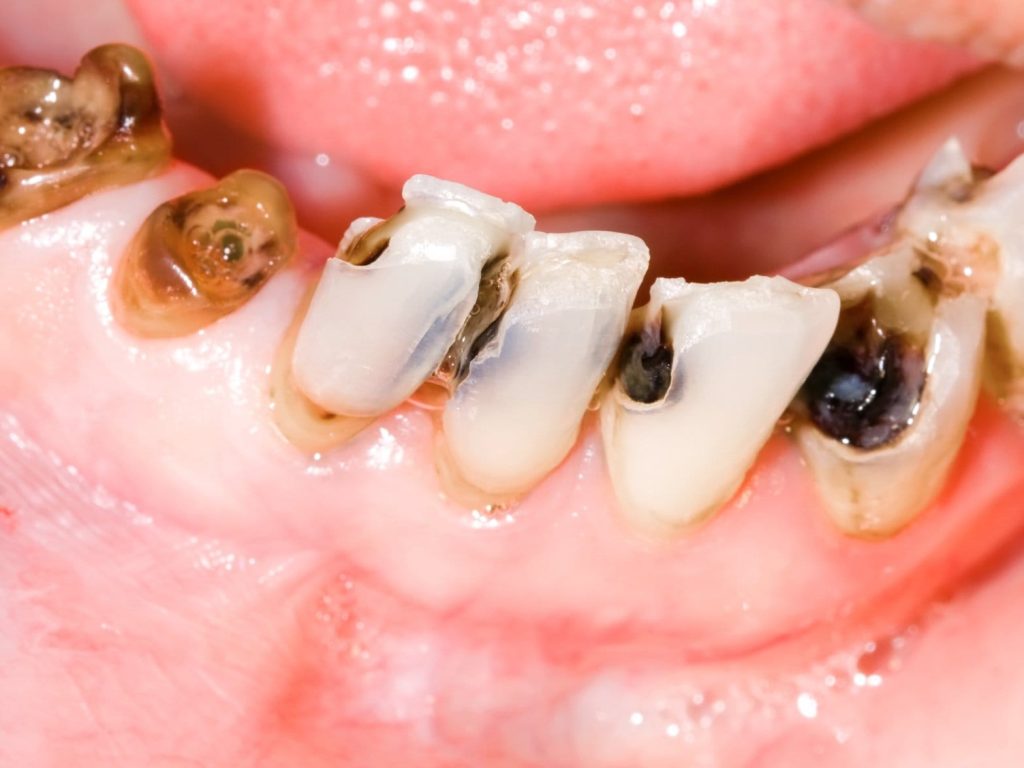 Tooth decay