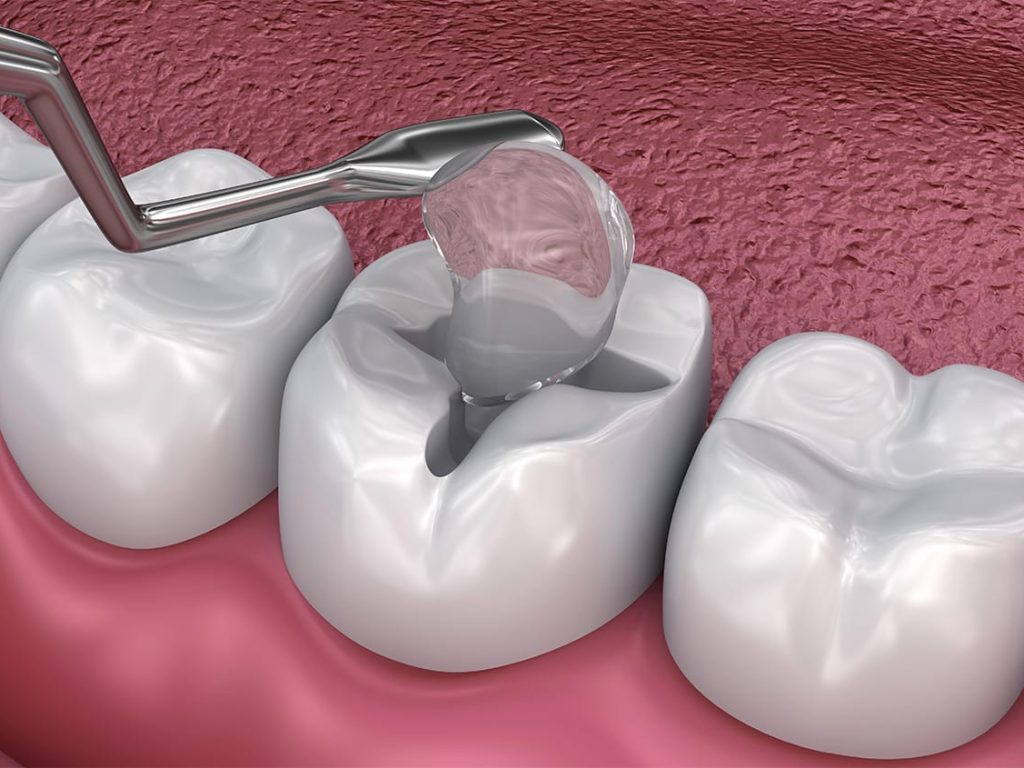 Dental filling